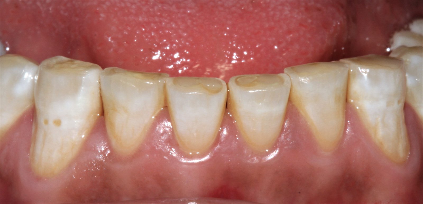 Férula de descarga  Clínica Dental Feito